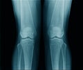 high quality x-ray knee joint of old man Royalty Free Stock Photo