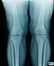 High quality x-ray knee joint of old man Royalty Free Stock Photo