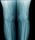 high quality x-ray knee joint of old man Royalty Free Stock Photo