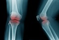 high quality x-ray knee joint of old man Royalty Free Stock Photo