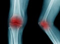 high quality x-ray knee joint of old man Royalty Free Stock Photo