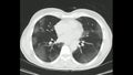 Computed Tomography of the chest high resolution CT chest in a confirmed case of COVID-19 Corona virus