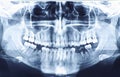 High resolution panoramic dental radiography