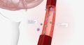 High volumes of lymphocytes, macrophages, and other immune cells infiltrate the inflamed aorta