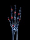 Highlighted arthritic hand Royalty Free Stock Photo