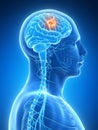 Highlighted brain tumor Royalty Free Stock Photo