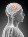 Highlighted brain tumor Royalty Free Stock Photo