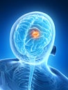 Highlighted brain tumor Royalty Free Stock Photo