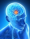 Highlighted brain tumor Royalty Free Stock Photo