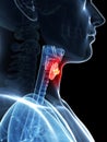 Highlighted thyroid cancer Royalty Free Stock Photo