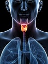 Highlighted thyroid cancer Royalty Free Stock Photo