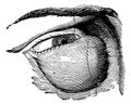 Highly Developed Lacrimal Tumor, vintage engraving