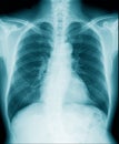 Hight qaulity chest x-ray image