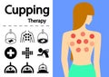 Hijama or Cupping Therapy Icons in flat vector art Royalty Free Stock Photo