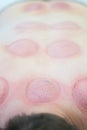 Hijama - the treatment of bloodletting. Scars at the end of process Royalty Free Stock Photo