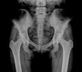 Hip Bone Xray, Human Body