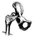 Hip Dislocation upon the Dorsum Illi, vintage illustration Royalty Free Stock Photo