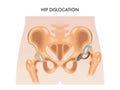 Hip dislocation illustration