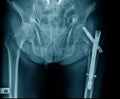Hip fixation for old patient with hip fracture Royalty Free Stock Photo