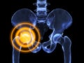 Hip inflammation