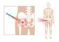 Hip joint injection