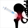 Hip joint injection Royalty Free Stock Photo