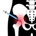 Hip joint injection Royalty Free Stock Photo