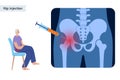 Hip joint injection Royalty Free Stock Photo