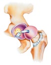 Hip - Joint Opened Lateral View