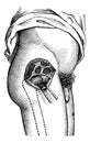 Hip joint opened by the outside, to show the neck of the femur, vintage engraving