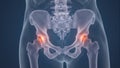 Hip joint with osteoarthritis bone spurs detailed anatomy educational visualization Royalty Free Stock Photo