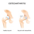 Hip joint with osteoarthritis