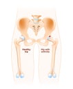 Hip joint with osteoarthritis Royalty Free Stock Photo