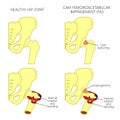 Hip joint problem_Cam femoroacetabular impingement Royalty Free Stock Photo