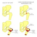 Hip joint problem_Mixed femoroacetabular impingement with section