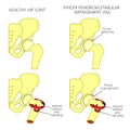 Hip joint problem_Pincer femoroacetabular impingement with section Royalty Free Stock Photo