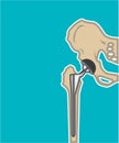 Hip Joint Replacement