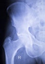 Hip joint surgical implant xray scan Royalty Free Stock Photo