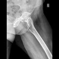 Hip joint x-ray image lateral view