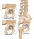 Hip Labral Tears. Labrum torn from socket and Repaired labrum. Surgery for Repairing a Torn Hip Labral