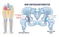 Hip osteoarthritis bone disease with painful skeletal spurs outline diagram