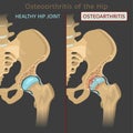 Hip Osteoarthritis Image