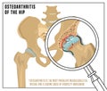 Hip Osteoarthritis Image