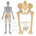 Hip Osteoarthritis Image Royalty Free Stock Photo