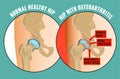 Hip Osteoarthritis Infographic