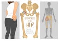 Hip Osteoarthritis Infographic