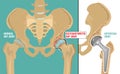 Hip Osteoarthritis Poster