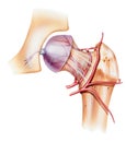 Hip - Osteonecrosis of the Femoral Head