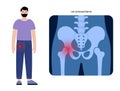 Hip pain and disease Royalty Free Stock Photo