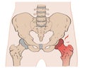 Hip pain. In the hip joint, the head of the femur (thighbone) swivels within the acetabulum. Royalty Free Stock Photo